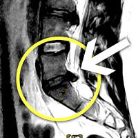 MRIġ���� �̹���