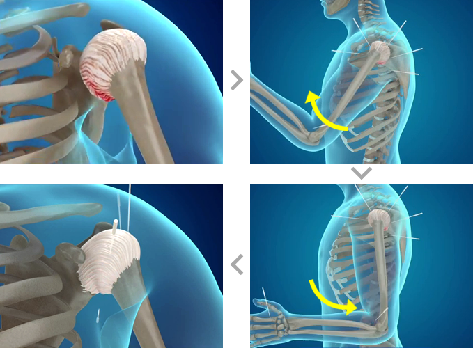 어깨 관절에 염증 등으로 통증이 있는 상태, 침을 꼿은 후 위,아래로 팔을 움직이는 상태,  염증, 통증이 줄어드는 상태의 3D 이미지 입니다.